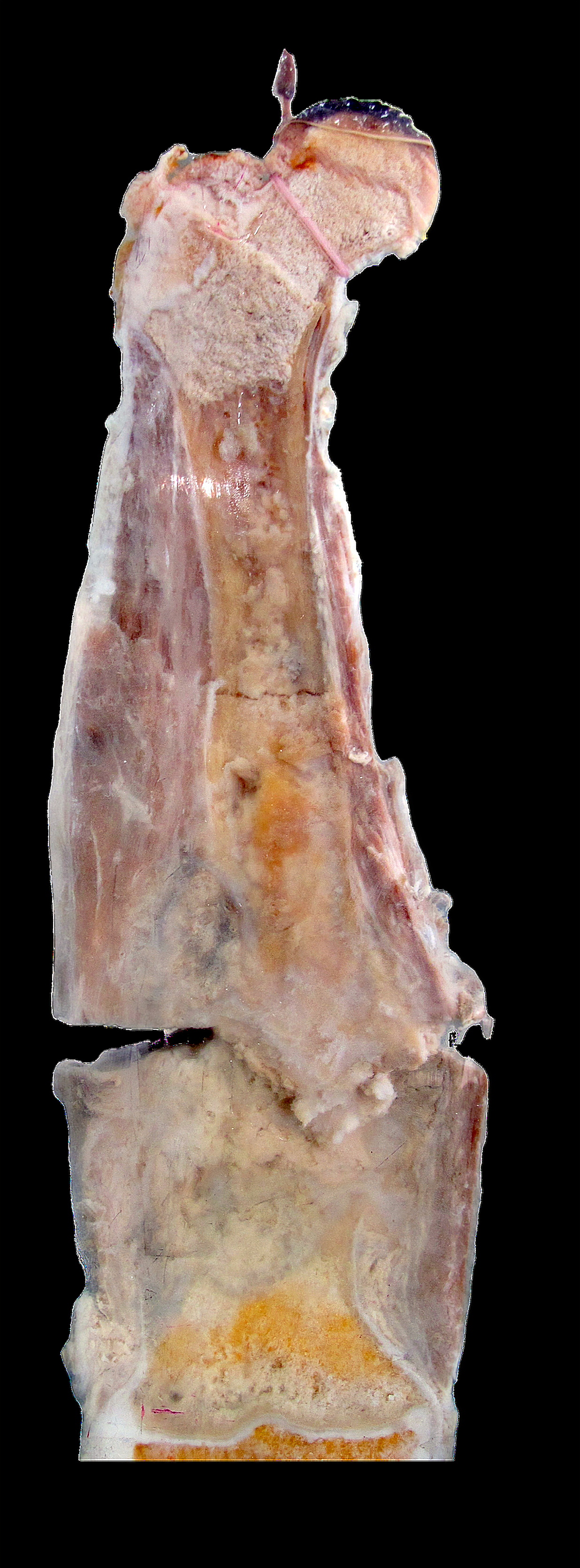 Osteosarkom